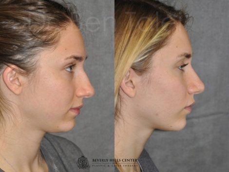 Minimally Invasive Rhinoplasty & Nostril Lightening - Right Side