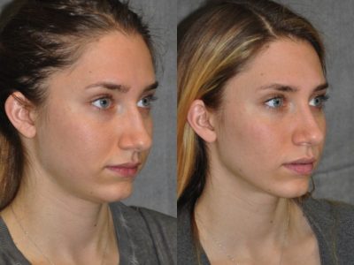 Minimally Invasive Rhinoplasty & Nostril Lightening - Right Side