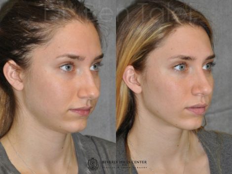 Minimally Invasive Rhinoplasty & Nostril Lightening - Right Side