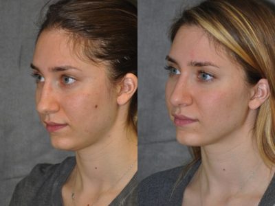 Minimally Invasive Rhinoplasty & Nostril Lightening - Left Side