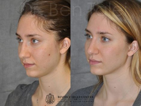 Minimally Invasive Rhinoplasty & Nostril Lightening - Left Side