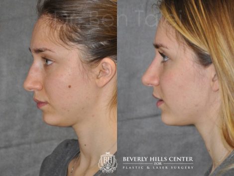 Beverly Hills Center Female Patient Before and After Cheek Mole Removal