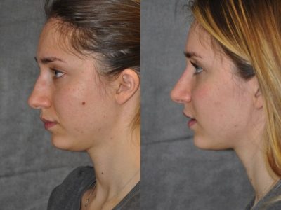 Minimally Invasive Rhinoplasty & Nostril Lightening - Left Side