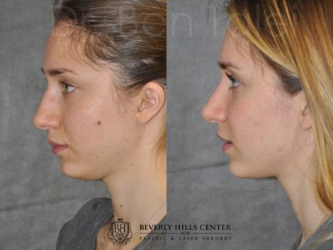 Minimally Invasive Rhinoplasty & Nostril Lightening - Left Side