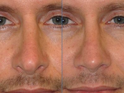 Natural Revision Rhinoplasty - Front
