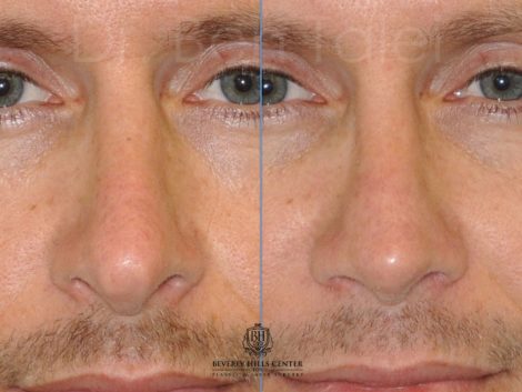 Natural Revision Rhinoplasty - Front