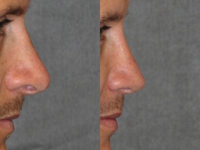 Natural Revision Rhinoplasty - Right Side
