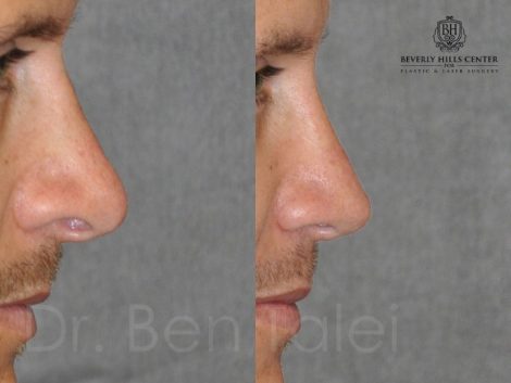 Natural Revision Rhinoplasty - Right Side