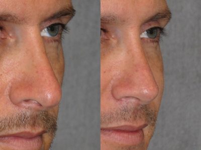 Natural Revision Rhinoplasty - Right Side