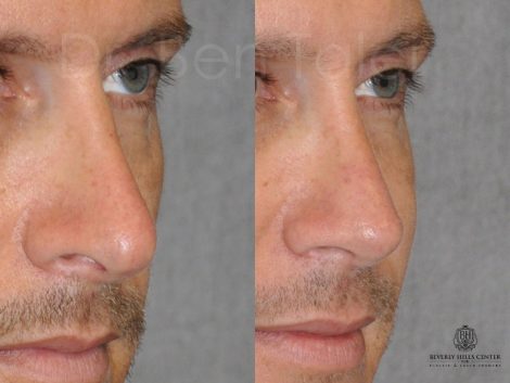 Natural Revision Rhinoplasty - Right Side