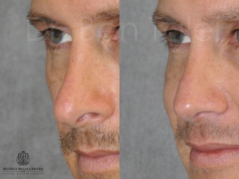 Beverly Hills Center Male Patient Before and After Natural Revision Rhinoplasty Procedure