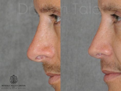 Beverly Hills Center Male Patient Before and After Natural Revision Rhinoplasty Procedure