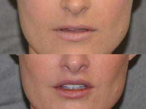 Patient Before and After Lip Lift