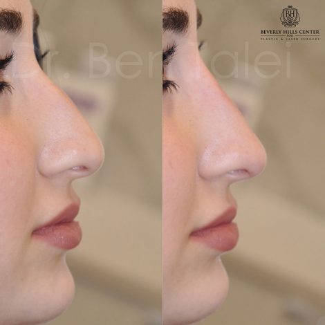 Beverly Hills Center Female Patient Before and After Non-surgical Liquid Rhinoplasty