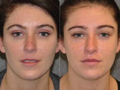 Modified Upper Lip Lift to change lip character - Front
