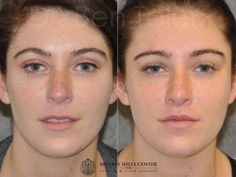 Modified Upper Lip Lift to change lip character - Front