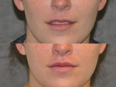 Modified Upper Lip Lift to change lip character - Front