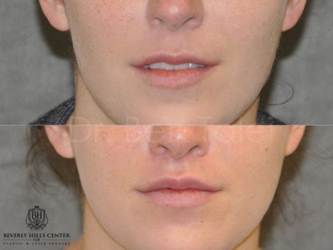 Modified Upper Lip Lift to change lip character - Front