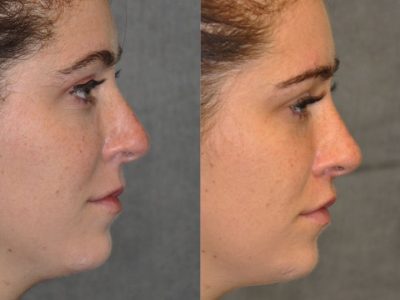Modified Upper Lip Lift to change lip character - Right Side