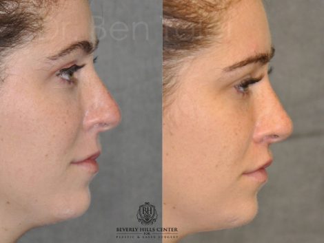 Modified Upper Lip Lift to change lip character - Right Side