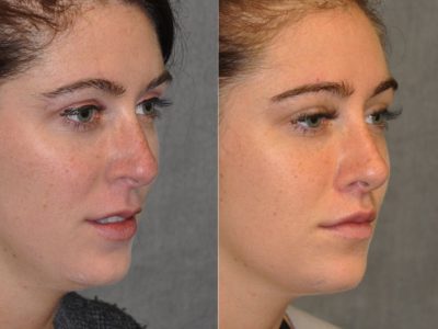 Modified Upper Lip Lift to change lip character - Right Side