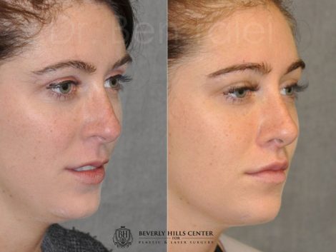 Modified Upper Lip Lift to change lip character - Right Side