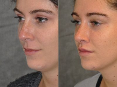 Modified Upper Lip Lift to change lip character - Left Side