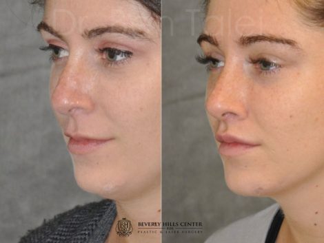 Modified Upper Lip Lift to change lip character - Left Side