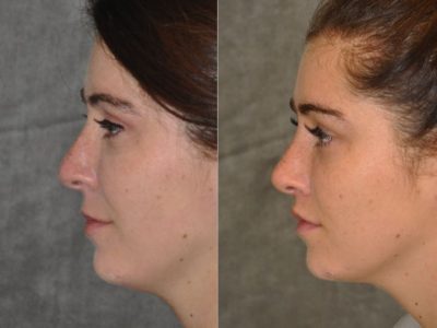 Modified Upper Lip Lift to change lip character - Left Side