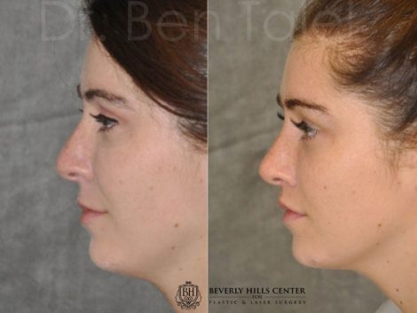 Modified Upper Lip Lift to change lip character - Left Side