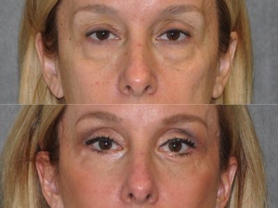 Upper & Lower Eyelid Lift with Fat Repositioning - Front