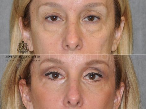 Upper & Lower Eyelid Lift with Fat Repositioning - Front