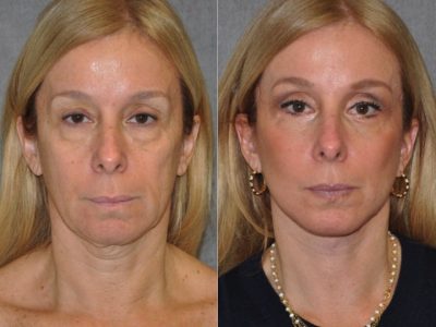 AuraLyft and Eyelid Rejuvenation - Front