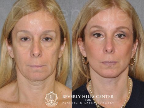 AuraLyft and Eyelid Rejuvenation - Front