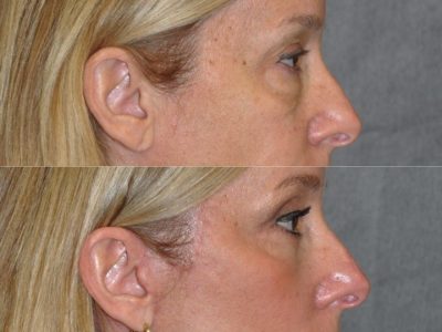 Upper & Lower Eyelid Lift with Fat Repositioning - Right Side