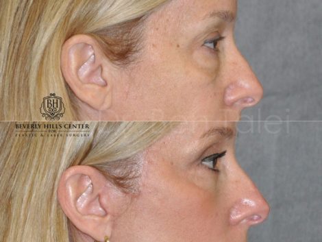 Upper & Lower Eyelid Lift with Fat Repositioning - Right Side