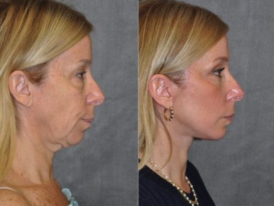 AuraLyft and Eyelid Rejuvenation - Right Side