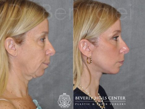 AuraLyft and Eyelid Rejuvenation - Right Side