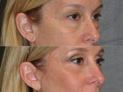 Upper & Lower Eyelid Lift with Fat Repositioning - Right Side