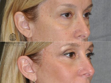 Upper & Lower Eyelid Lift with Fat Repositioning - Right Side