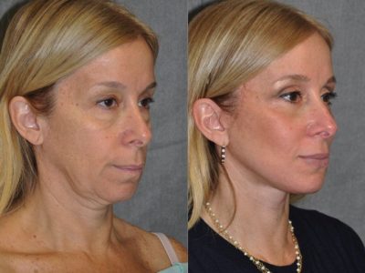 AuraLyft and Eyelid Rejuvenation - Right Side