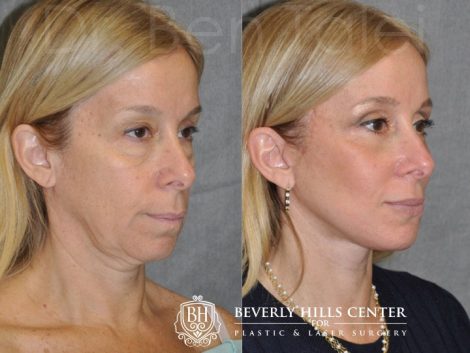 AuraLyft and Eyelid Rejuvenation - Right Side