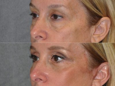 Upper & Lower Eyelid Lift with Fat Repositioning - Left Side