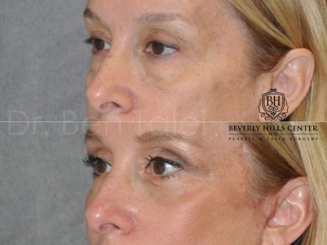 Upper & Lower Eyelid Lift with Fat Repositioning - Left Side