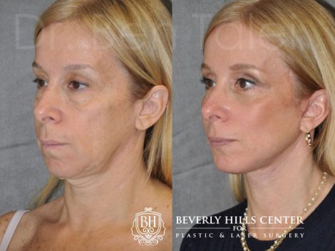 AuraLyft and Eyelid Rejuvenation - Left Side
