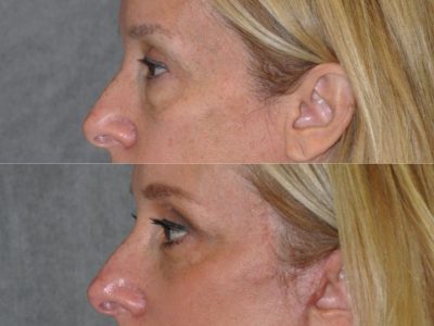 Upper & Lower Eyelid Lift with Fat Repositioning - Left Side