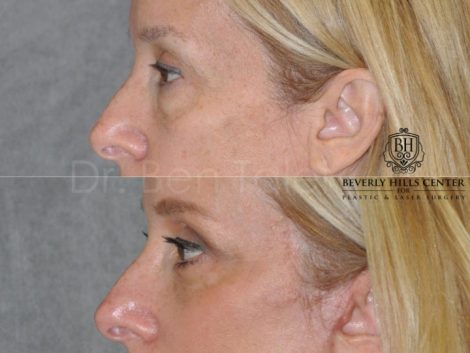 Upper & Lower Eyelid Lift with Fat Repositioning - Left Side