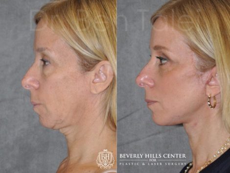 AuraLyft and Eyelid Rejuvenation - Left Side