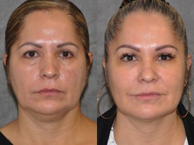Liquid Facelift using Botox and Fillers - Front