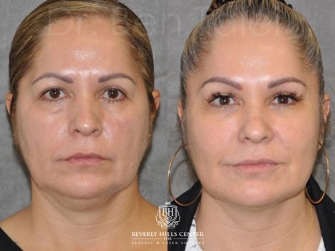 Liquid Facelift using Botox and Fillers - Front